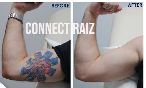 Evolution of Tattoo Removal Technology From Laser to Future Innovations